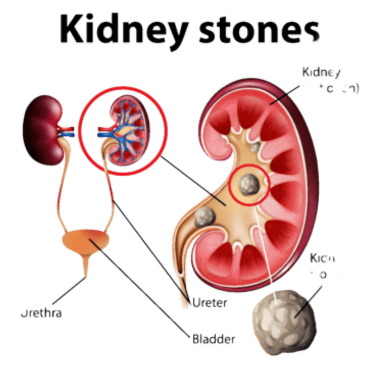 किडनी की पथरी