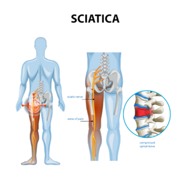 साइटिका