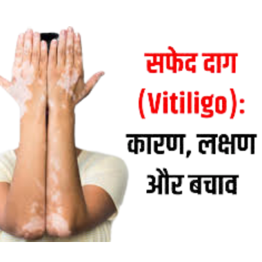 सफेद दाग