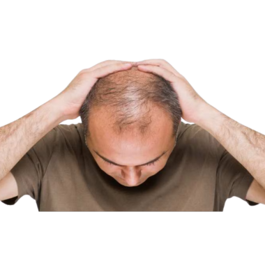 बाल झड़ना